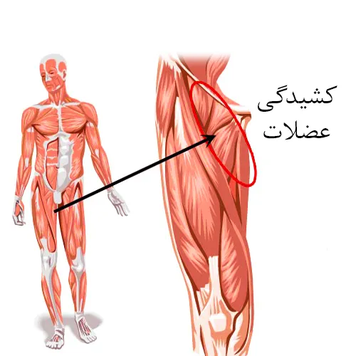پا درد در نتیجه کشیدگی عضلات
